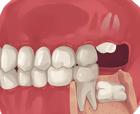 thumb1 procedures