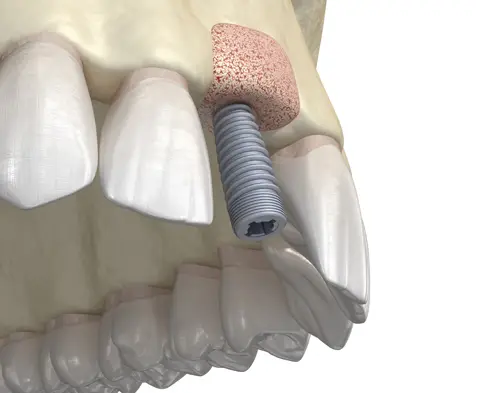thumb1 procedures