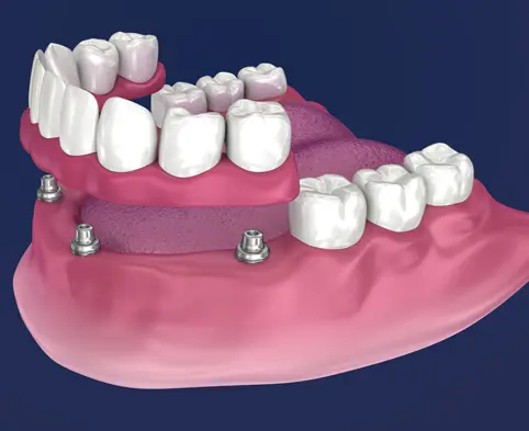 thumb1 procedures