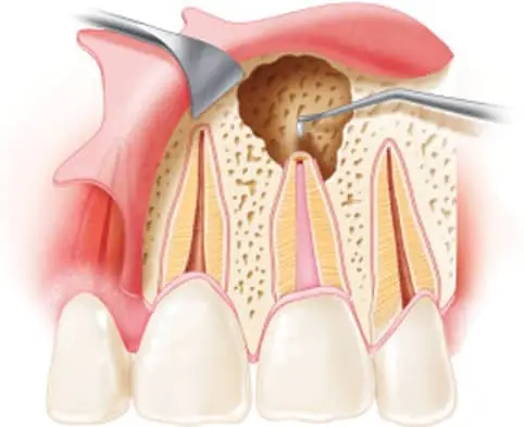 thumb1 procedures