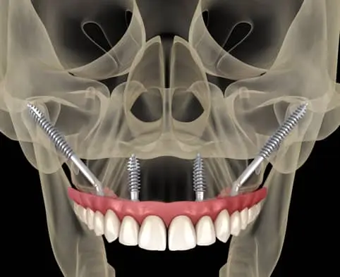 thumb1 procedures