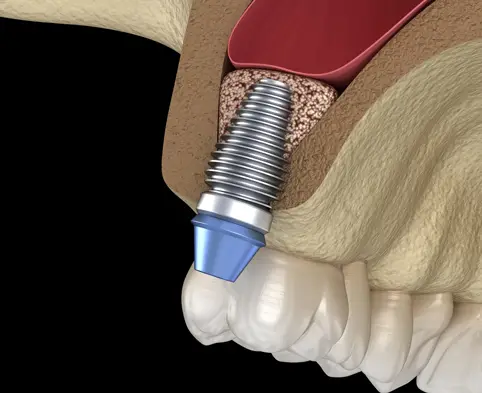 thumb1 procedures