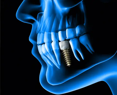 thumb1 procedures