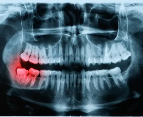 thumb1 procedures
