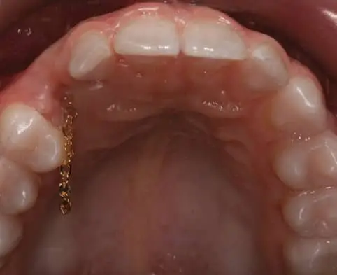 thumb1 procedures